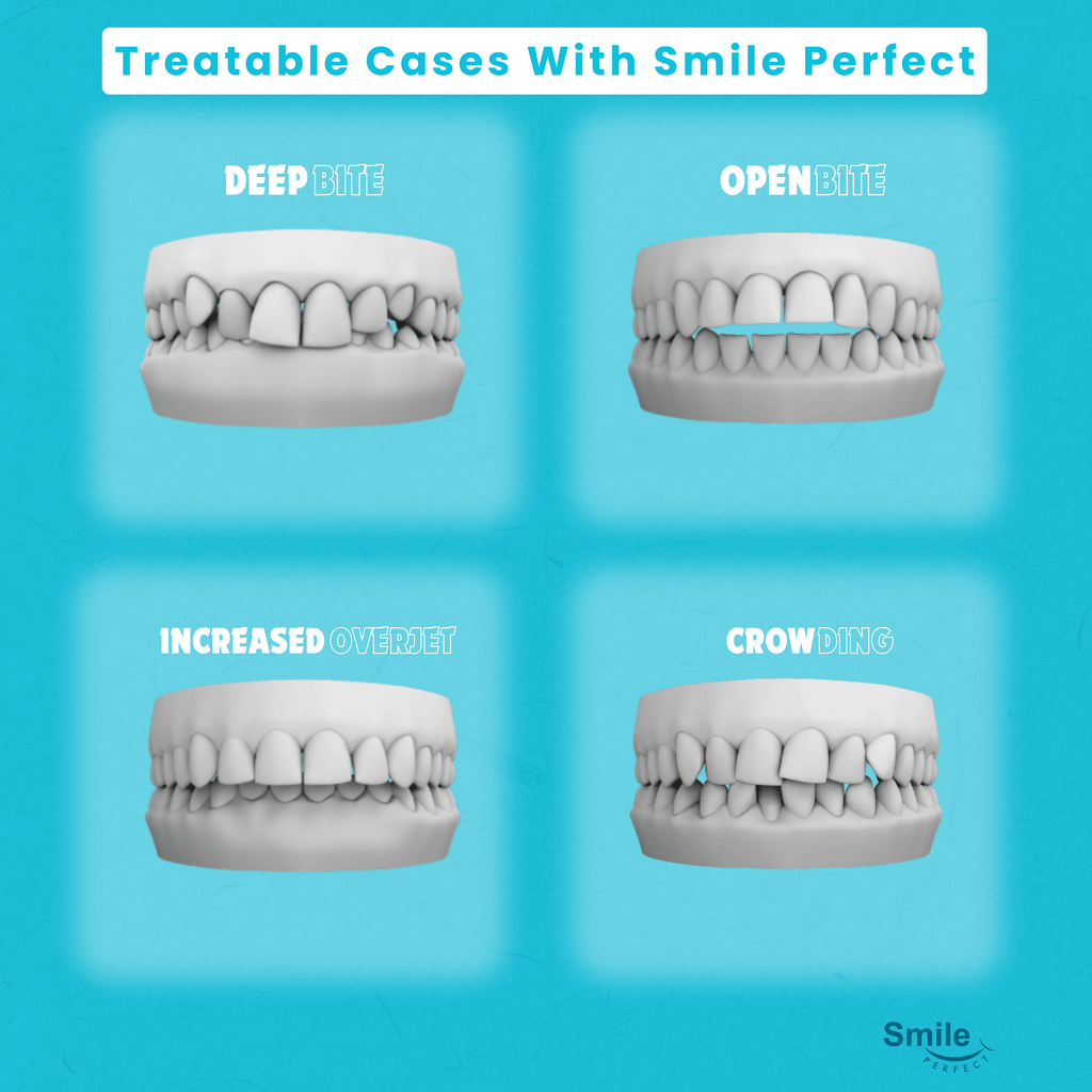 Clear Aligners Treatable Cases