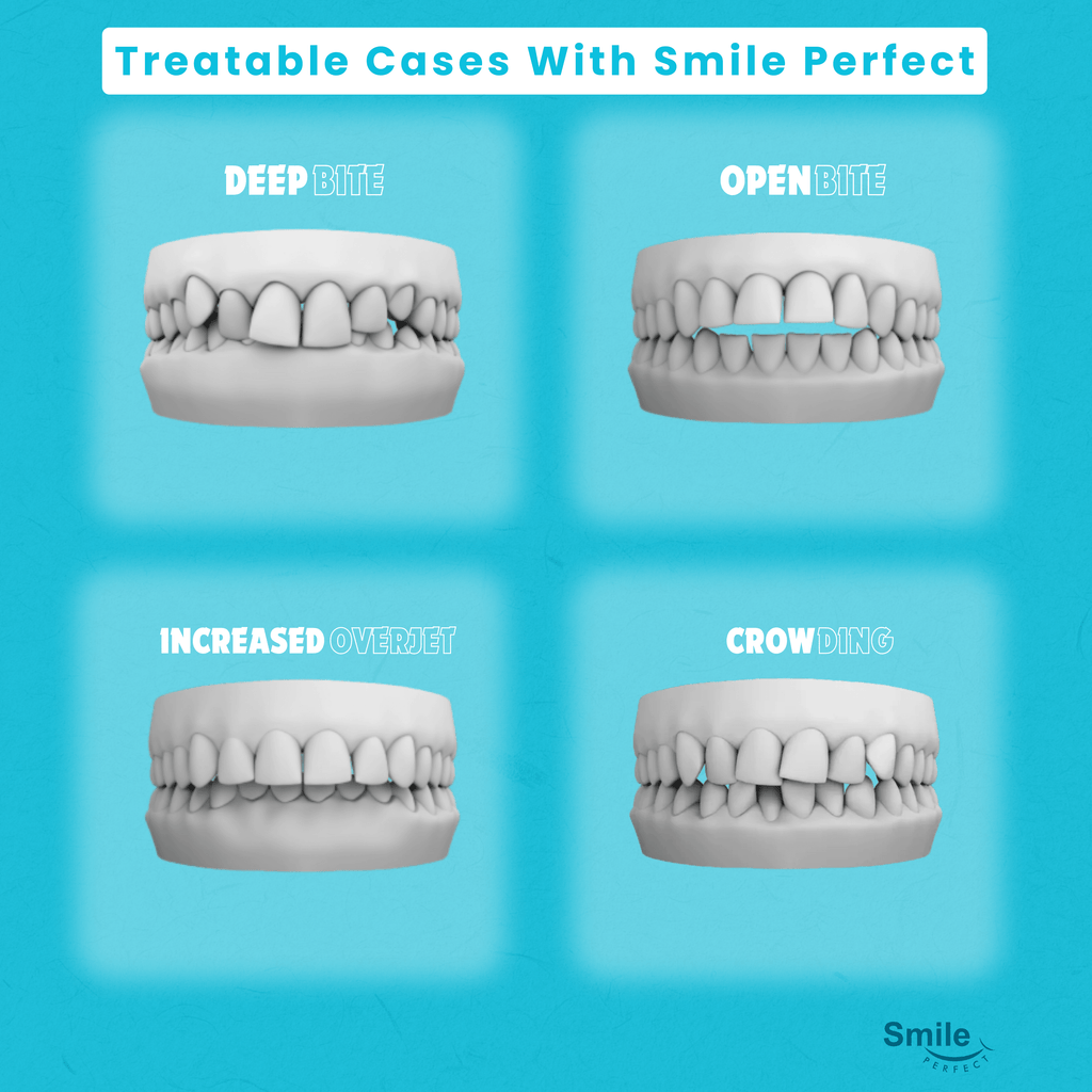 Smile Perfect Premium Single Arch